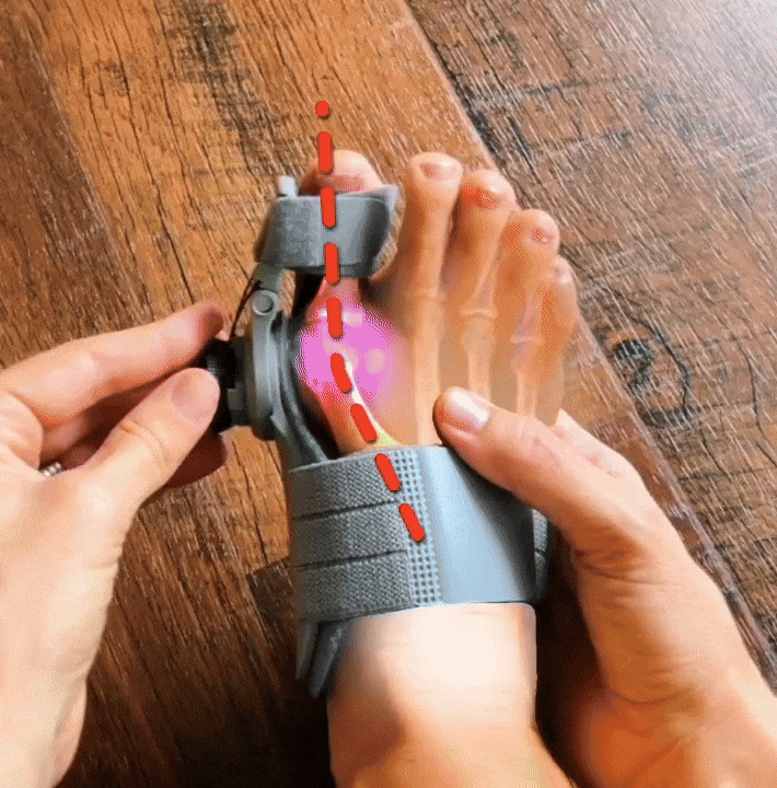 StepEase™ | Orthopedic Toe Straightener
