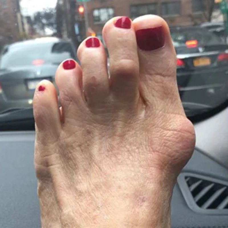 StepEase™ | Orthopedic Toe Straightener