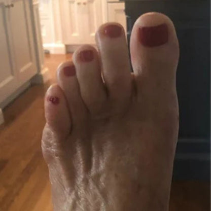 StepEase™ | Orthopedic Toe Straightener