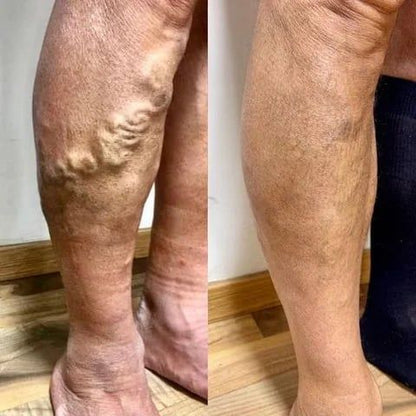 Kenko™ Spider & Varicose Vein Patches | Natural Herbal Therapy for Swelling, Fatigue & Vein Health